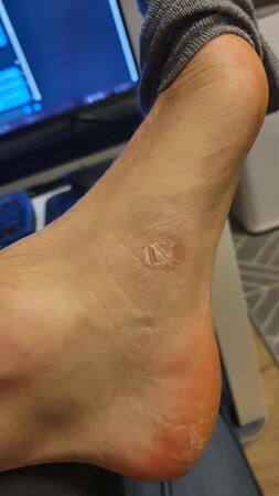 Blister